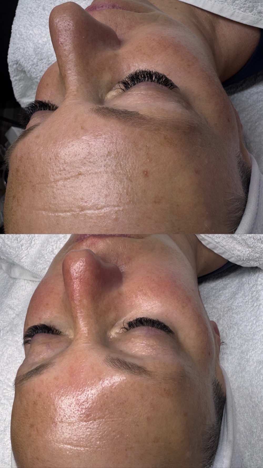Vorher-Nachher-Vergleich einer Aquafacial-Behandlung bei Beauty E&C Skin Expert