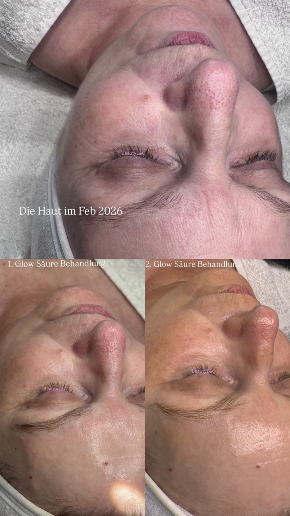 Hautverlauf über mehrere Fruchtsäurebehandlungen bei Beauty E&C Skin Expert